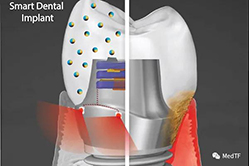 Smart Dental Implant：发光种植牙 让牙齿像钻石一样永流传